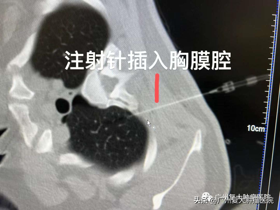 肺结节在内部如何切除,肺气管结节怎么治疗效果最好