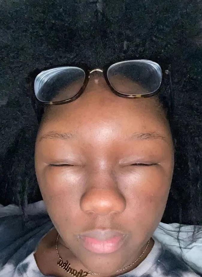 美国妹子染头发过敏全脸肿成emoji，不光失明还险些窒息