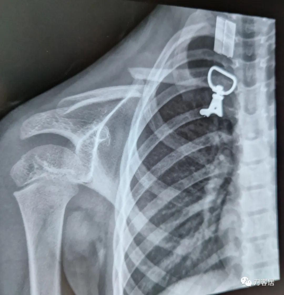 儿童锁骨骨折保守治疗的弊端,锁骨粉碎骨折错位不处理会愈合吗