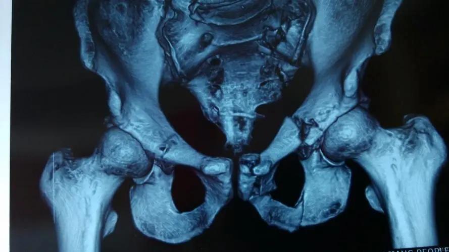 骨盆后环损伤后，新型螺钉的不同内固方法各有何优势？哪种方法好