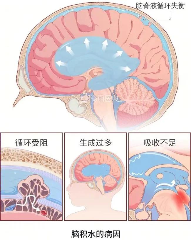 医生一转遥控器,我脑袋里的水就自动流进了肚子