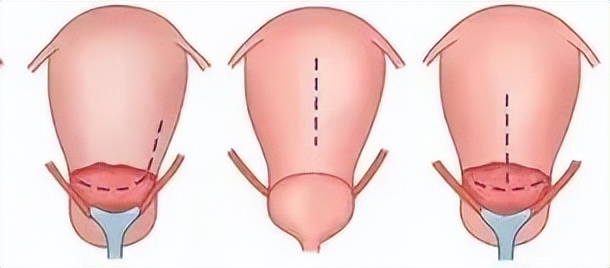 剖宫产切口选择哪个部位较好,剖宫产多久切口才会长好