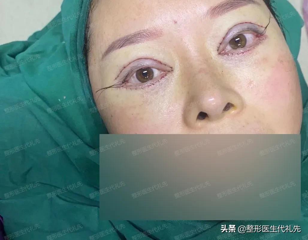 45岁适合做双眼皮全切手术吗,55岁双眼皮手术前后对比