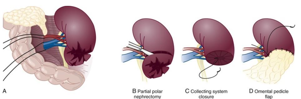 钝性闭合性肾损伤的诊治策略
