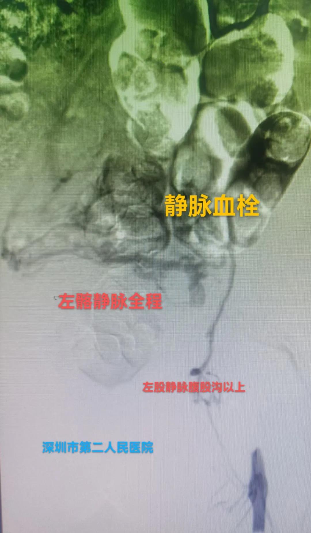 病人腿肿如何消除,病人腿肿了怎么回事