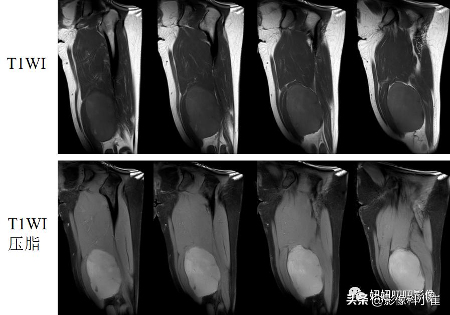 软组织肿块形成原因,软组织肿块怎么治最好