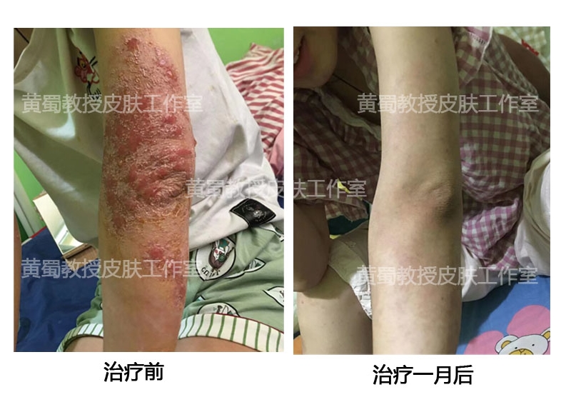 特应性皮炎中医疗法,特应性皮炎忌口食物一览表