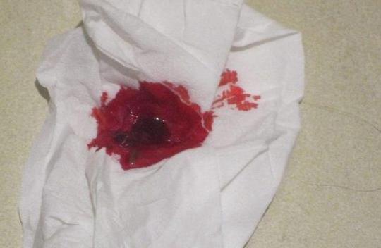 辣椒吃多了上厕所出血,昨天吃辣椒今天拉出血