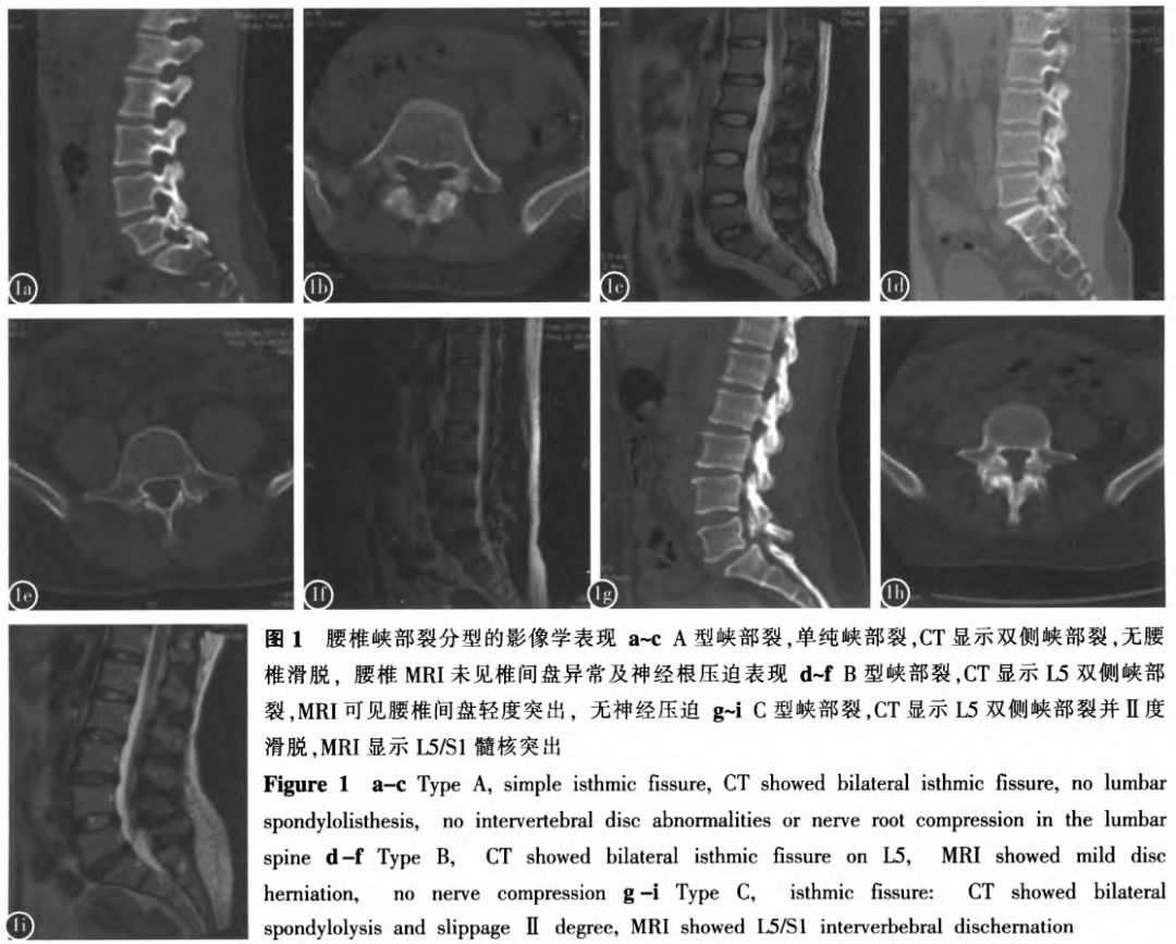 峡部裂和隐性峡部裂有区别吗,单纯峡部裂可以做峡部修复吗