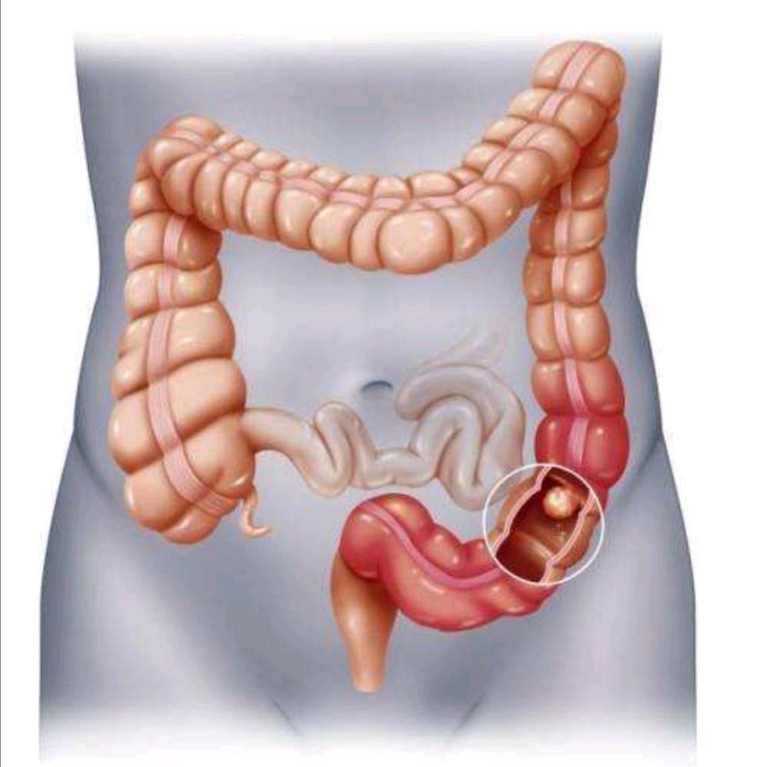 直肠前突肛门坠胀怎么治疗,治疗直肠前突有偏方吗