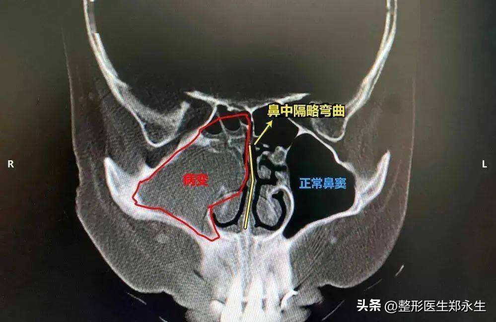 鼻中隔偏曲可以通过正骨矫正吗,鼻中隔偏曲矫正手术全过程真人