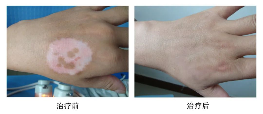 手部白斑治疗患者案例,手部白斑该咋诊疗呢