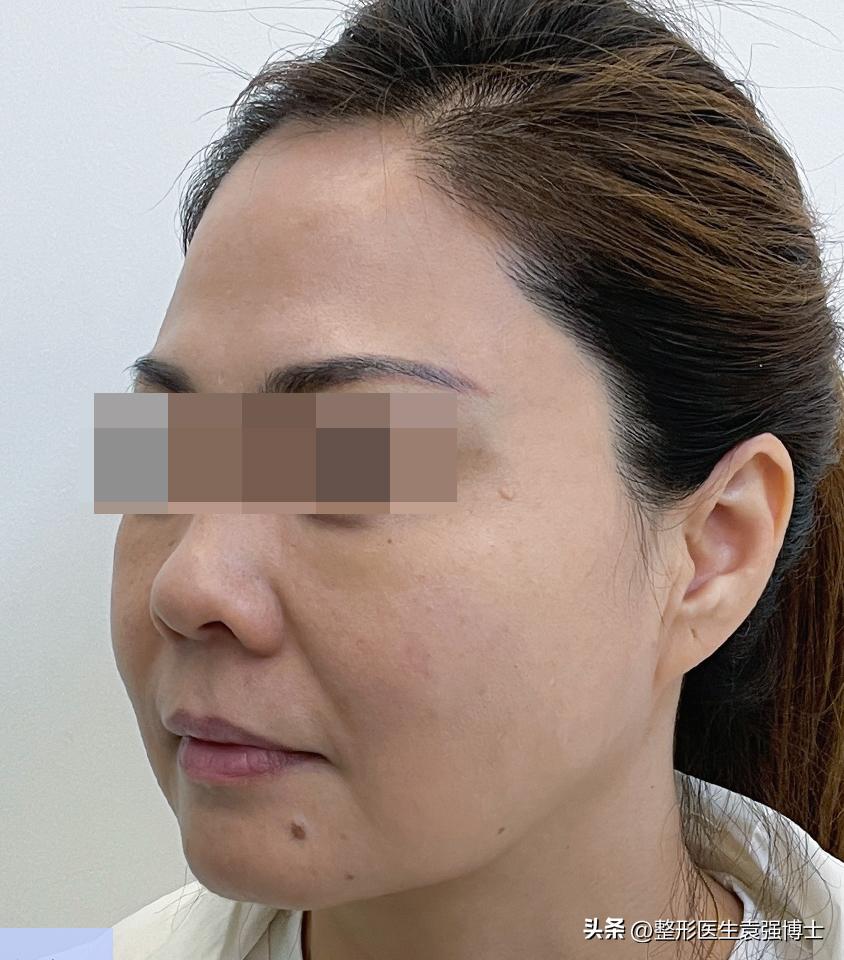 大拉皮多久可以修复大小脸,面部整体轻微松弛可以做大拉皮吗