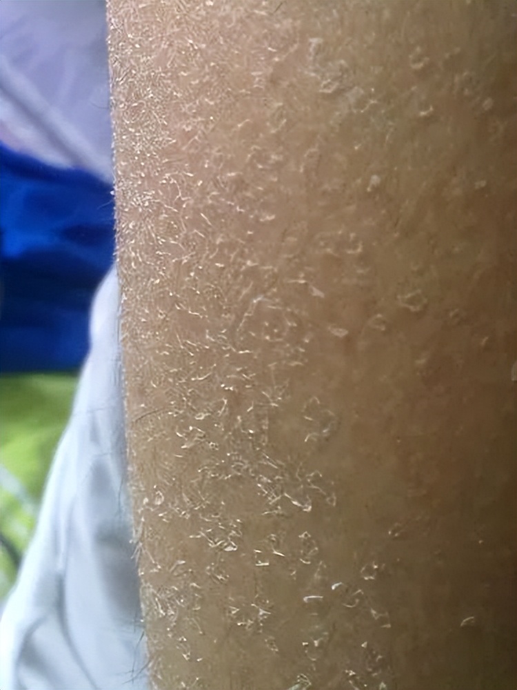 洗完澡身上痒还起皮是怎么回事,洗完澡皮肤干燥起皮浑身痒