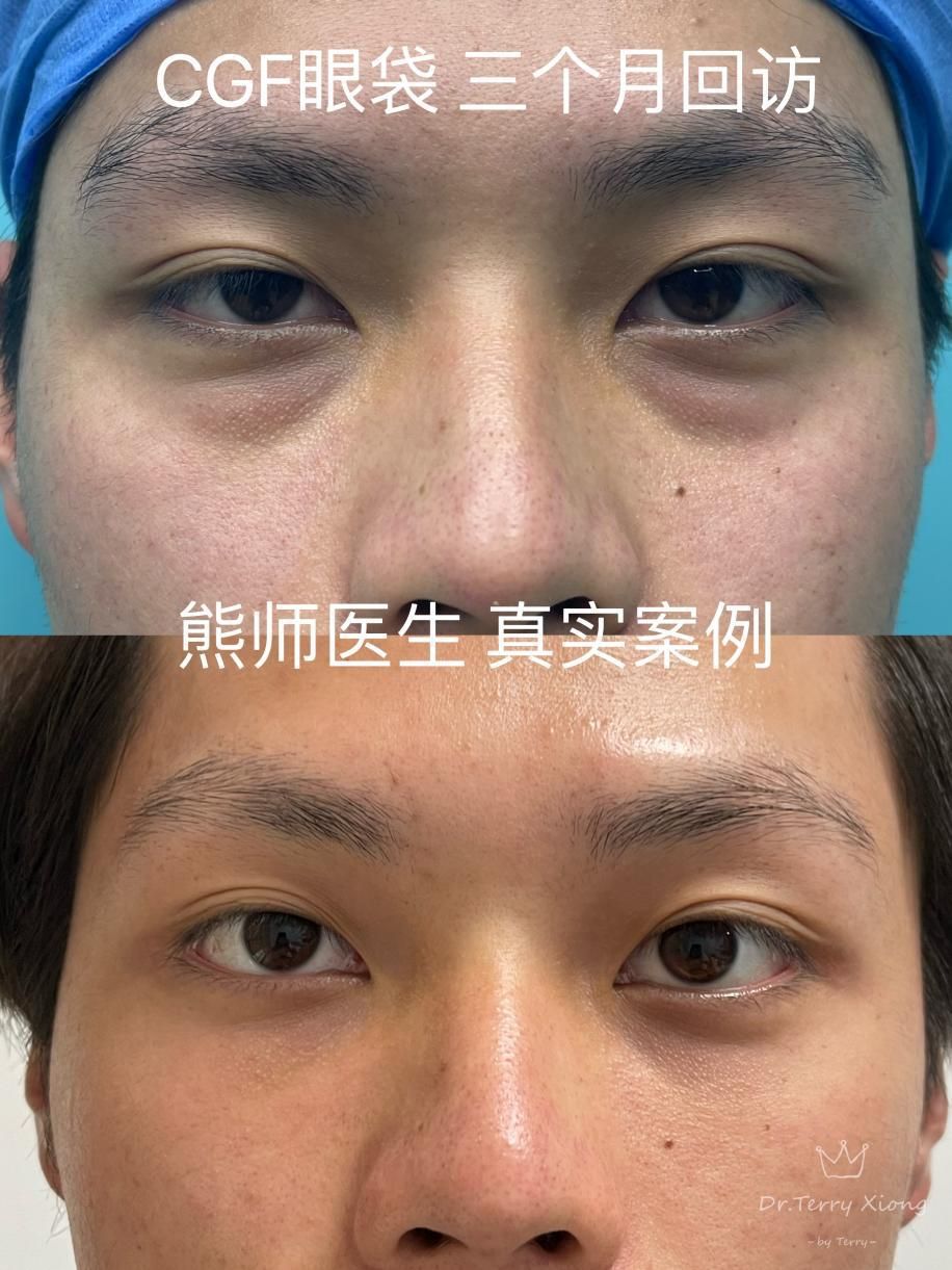 祛眼袋手术几月做恢复得最好,祛眼袋手术恢复期多久