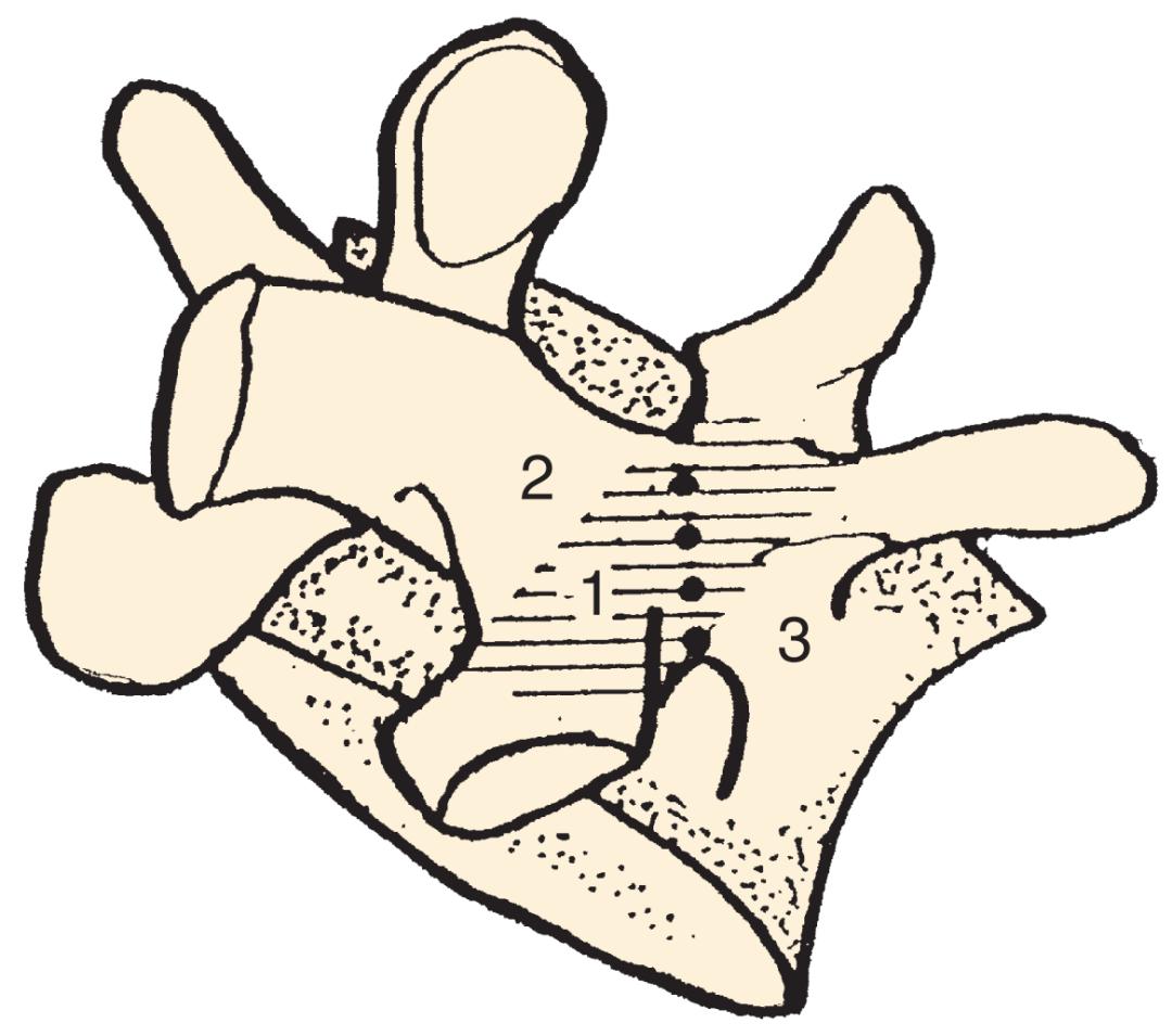 轻度峡部裂和重度峡部裂的区别,真性峡部裂和假性峡部裂