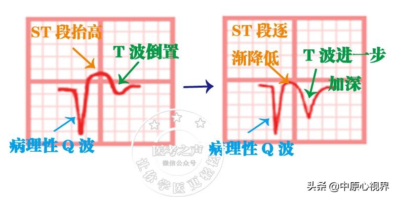 护考几种常见的心电图,常见的心电图图形分析