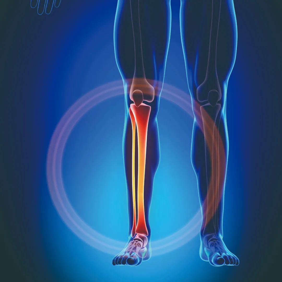 跑断腿现象,跑断腿是什么病