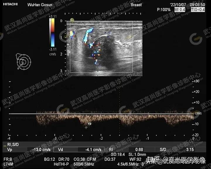 乳腺超声病例,乳腺肿块巨大超声结果4a