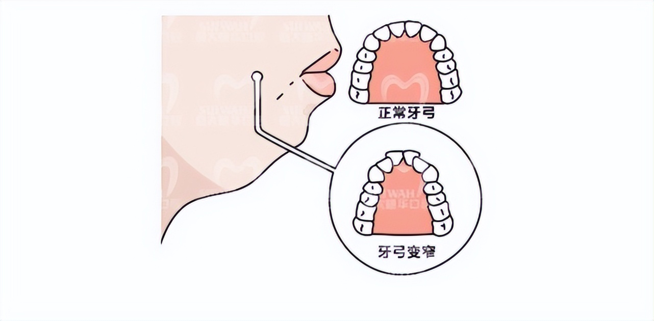 牙齿矫正拔牙和不拔牙有什么区别,牙齿矫正拔牙当天就可以矫正了吗