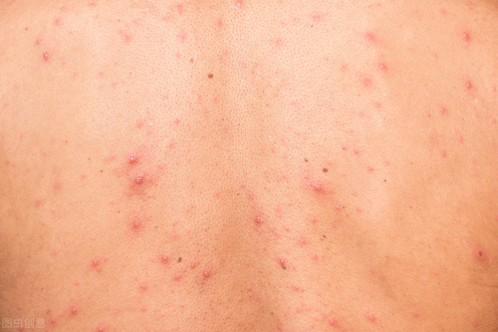 糖友秋冬季好发痒病，需正确分辨才好养病