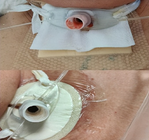 切口皮肤红肿,气切切口红肿怎么处理