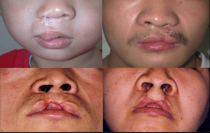 唇裂继发畸形修复全国哪家最好,宝宝唇裂畸形的手术修复费用