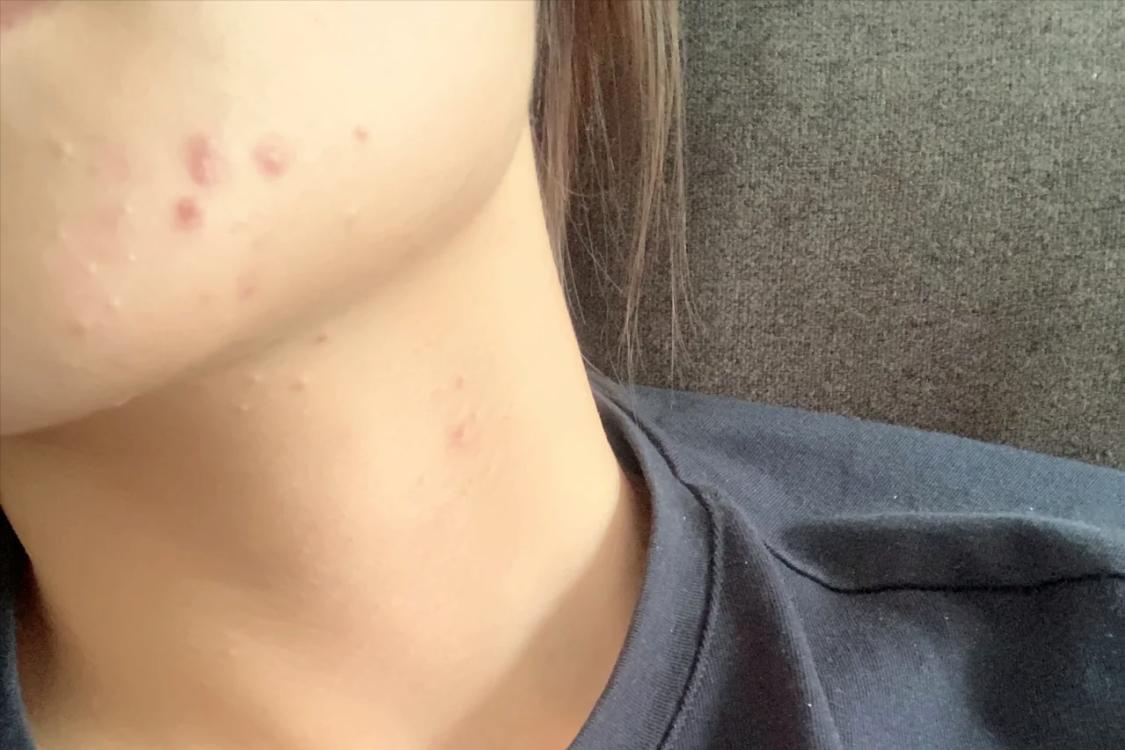 甲硝唑凝胶怎么用最好,甲硝唑凝胶用多久有效