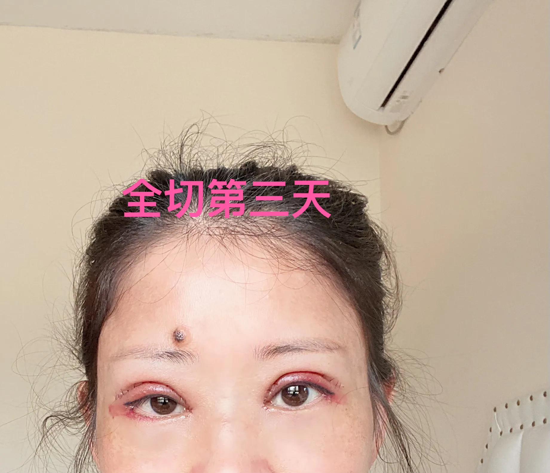 做双眼皮恢复期间能吃红糖吗,恢复最快的双眼皮