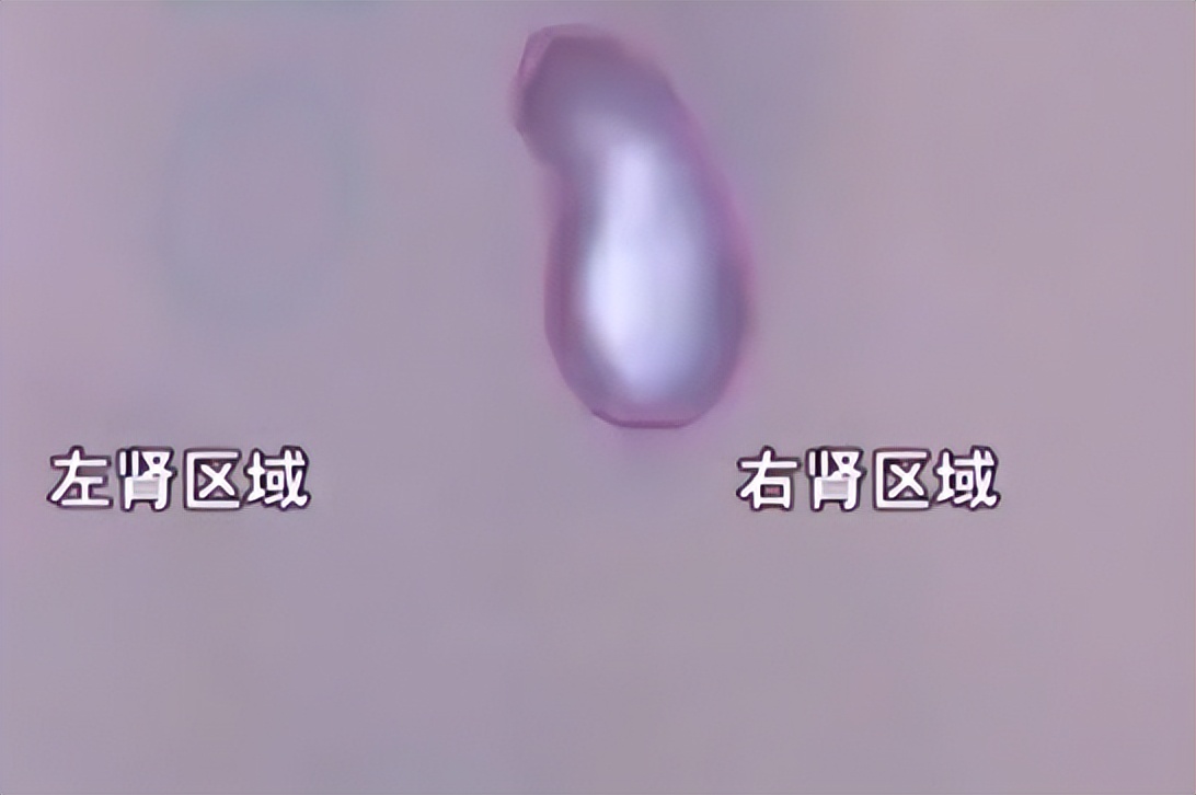 女孩单位体检时少一个肾最后结果,入职体检查出少个肾