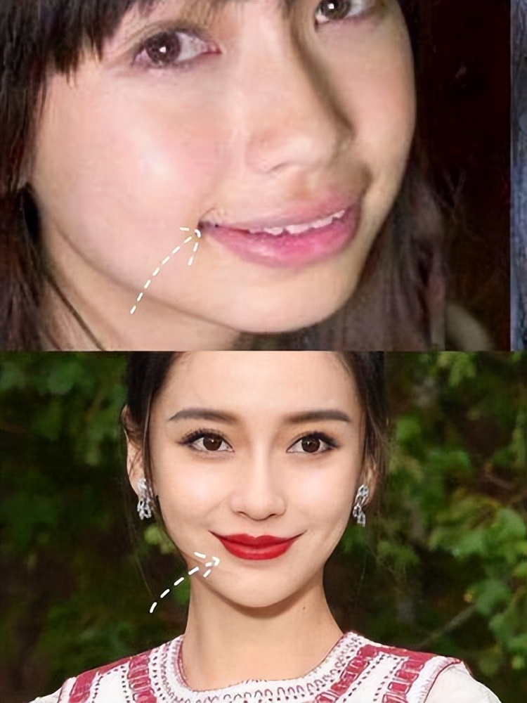 轻微嘴凸法令纹真的让人很自卑,法令纹严重是因为嘴凸吗