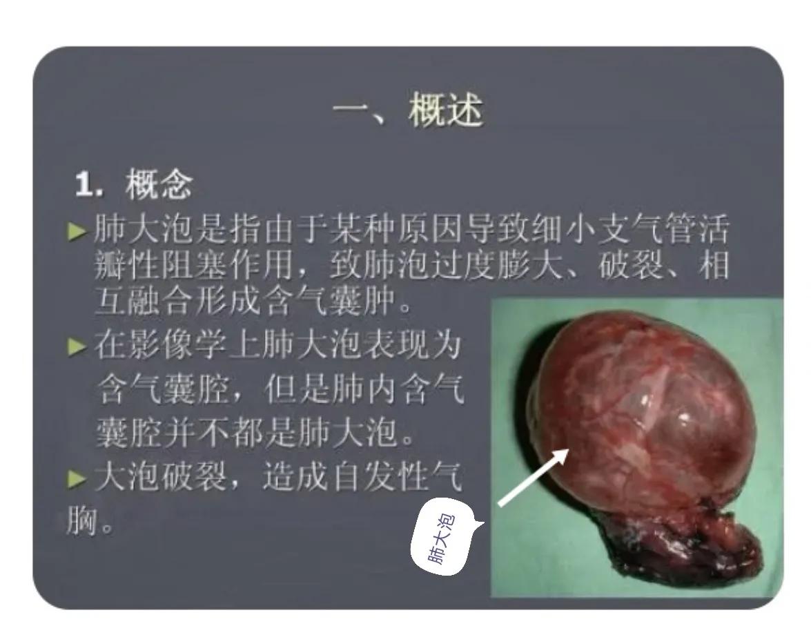 肺大泡产生的原因及治疗方案,肺大泡怎么治疗断根