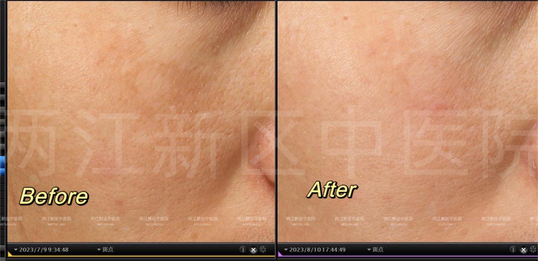 如何快速祛斑最有效方法,中药快速祛斑的有效方法