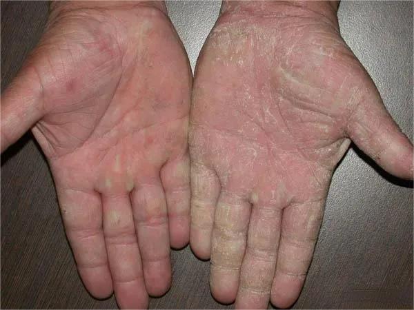 甲癣不严重怎么治疗,甲易生治疗灰指甲吗