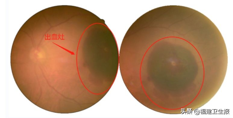 爱尔眼科专注摘镜手术,福州爱尔眼科医院技术