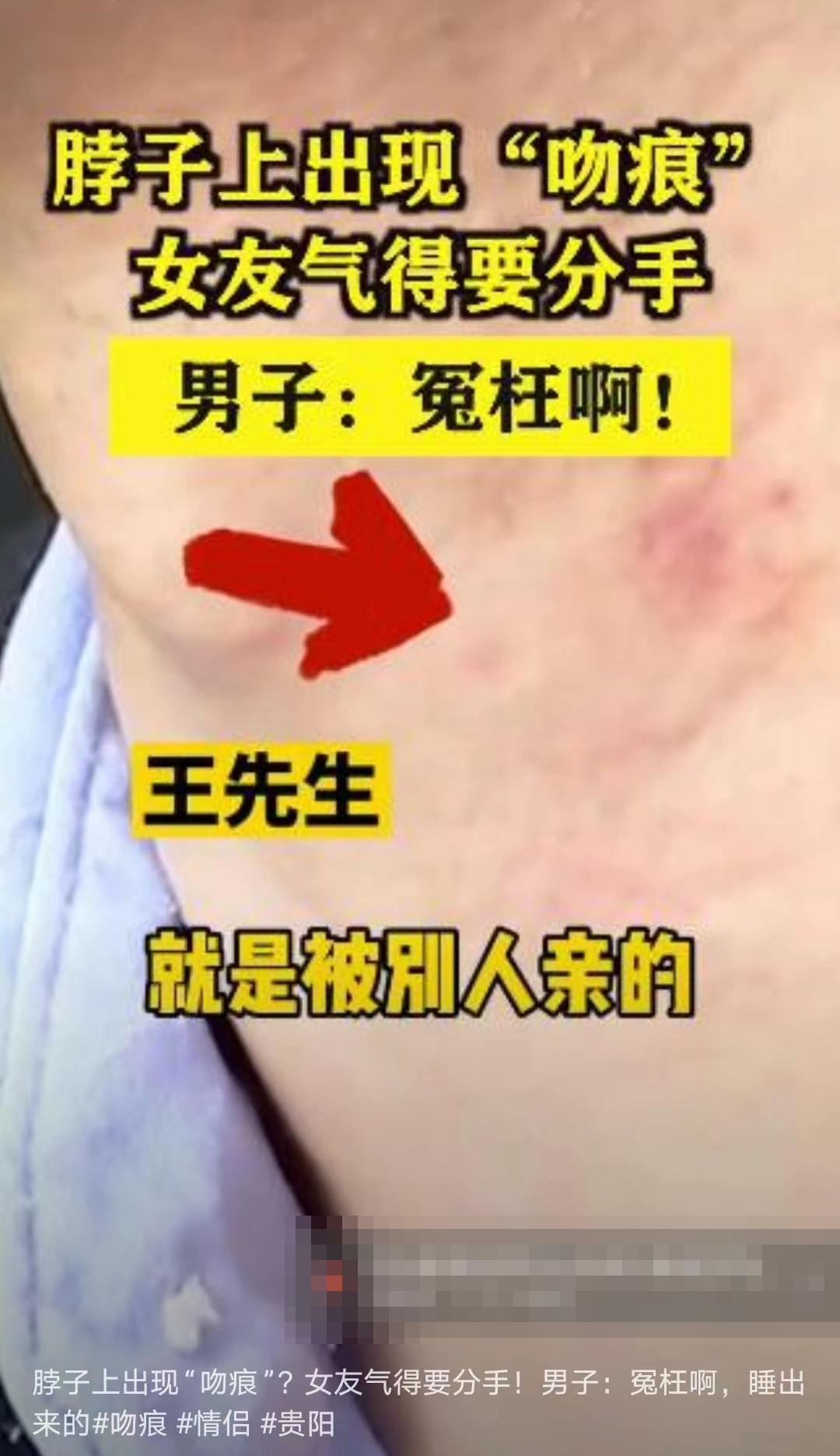 吻痕是不是出轨的证据,老公身上有吻痕可作为出轨证据吗