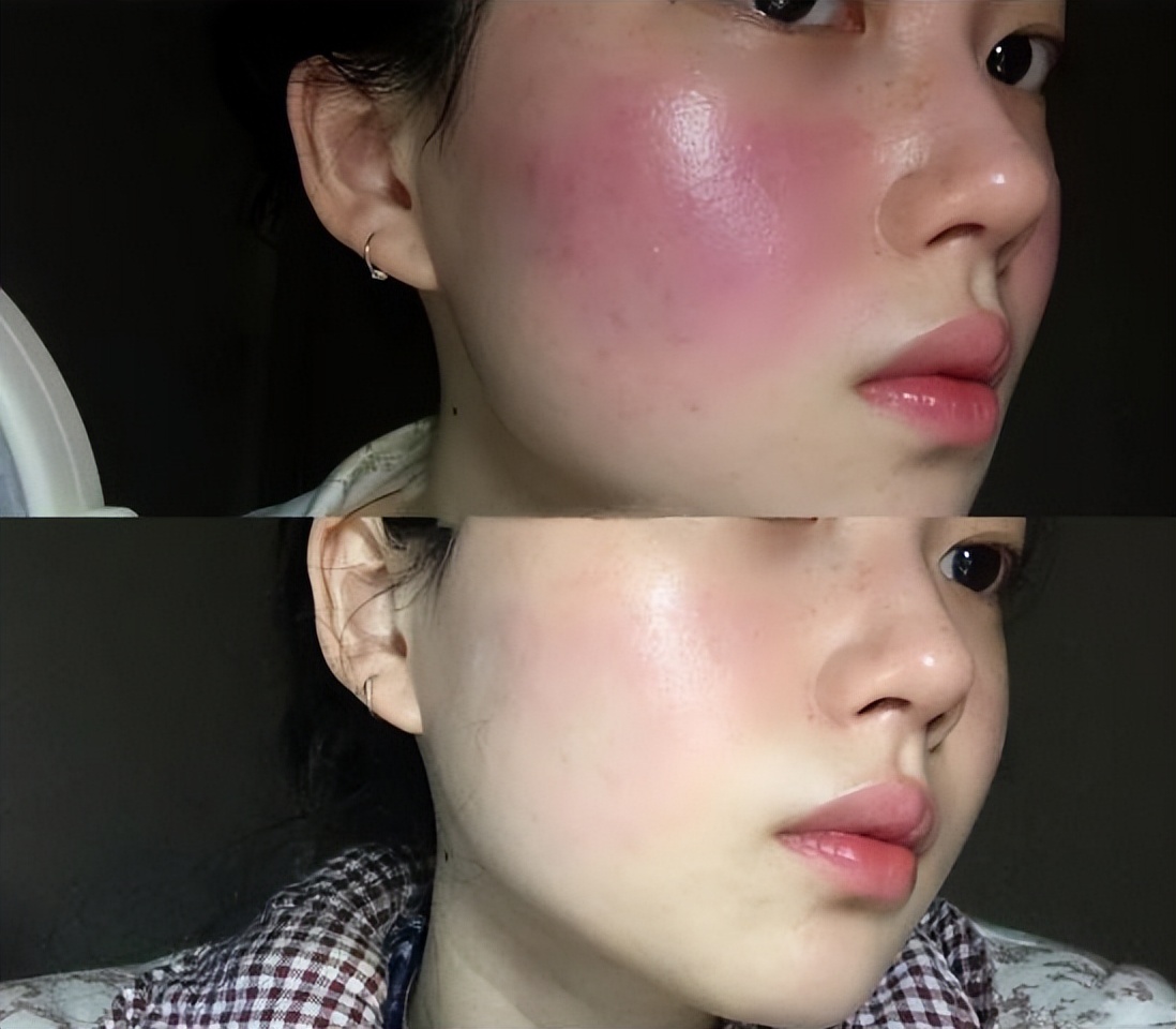 烂脸怎么养好皮肤,记住这几招轻松把皮肤养好