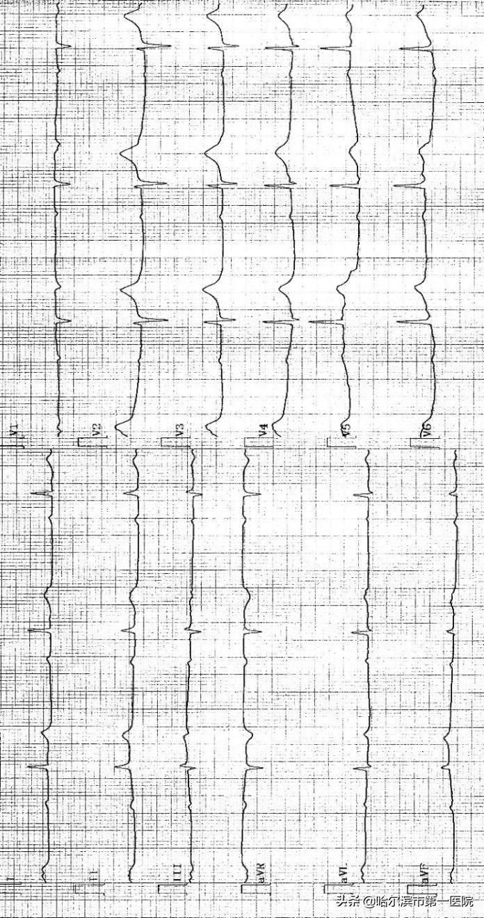 哈尔滨市第一医院心律失常起搏治疗开启新时代为高龄老人植入“抗核磁全自动超大电池容量”心脏双腔起搏器