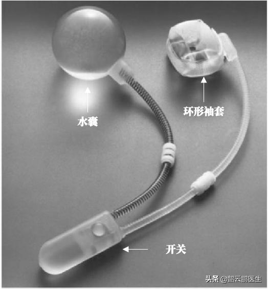 前列腺切除后需要终生戴尿不湿吗,做了前列腺漏尿最有效的恢复方法