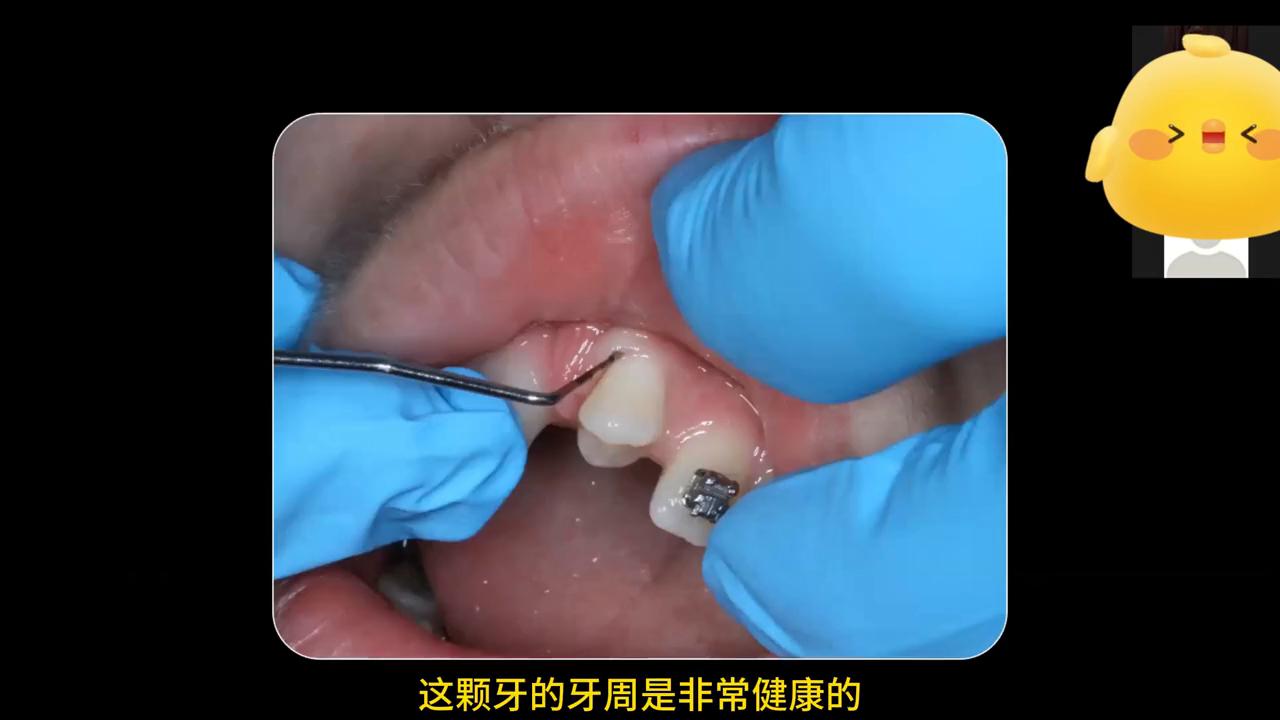 真实种牙视频全过程,种牙后悔的真实案例分析