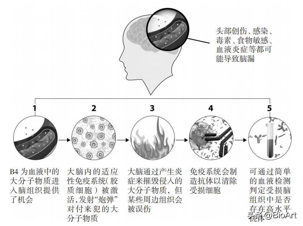脑漏的真正原因,肠漏症和脑漏症