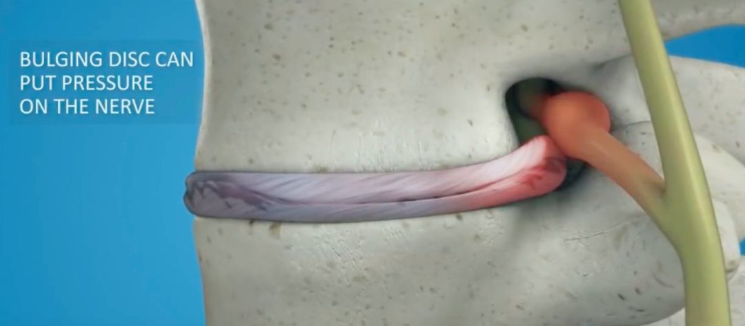 对于腰椎间盘突出症你真的了解吗,腰椎间盘突出的十个问题