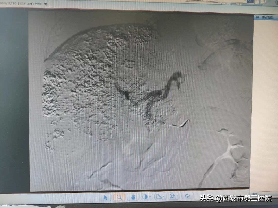 沈阳治疗肝血管瘤介入哪家医院好,肝血管瘤介入手术大概需要多少钱