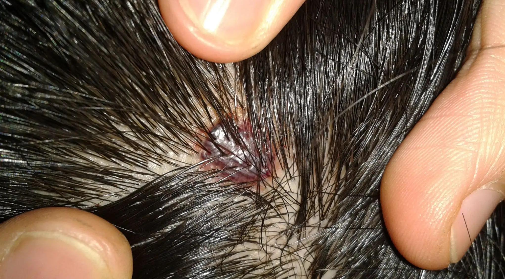 头皮总是长疙瘩是怎么回事,头皮上老长疙瘩怎么回事