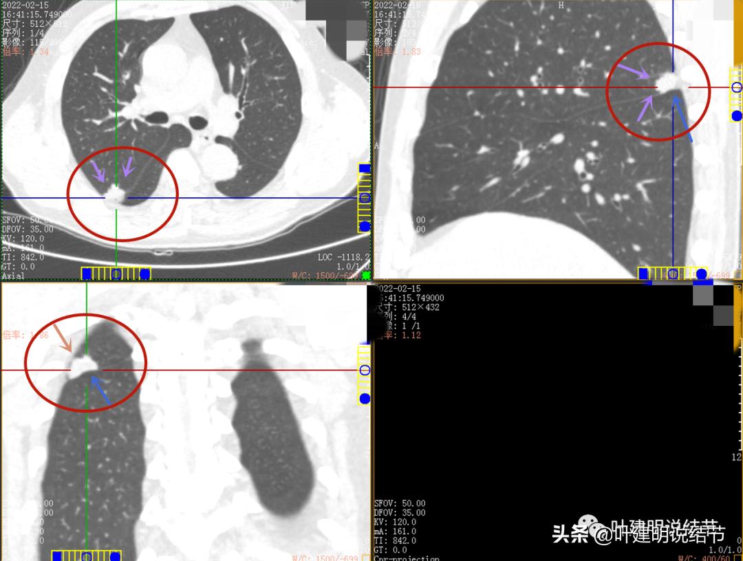 肺腺癌高危亚型什么意思,肺腺癌高危亚型
