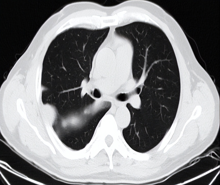 海南首例恶性胸膜间皮瘤,胸膜间皮瘤生存5年算治愈吗