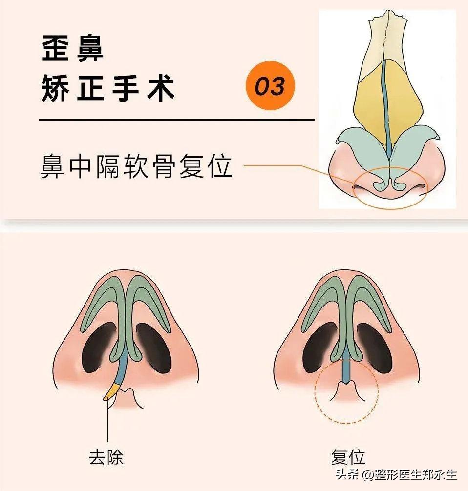 歪鼻是什么原因引起的,歪鼻歪鼻