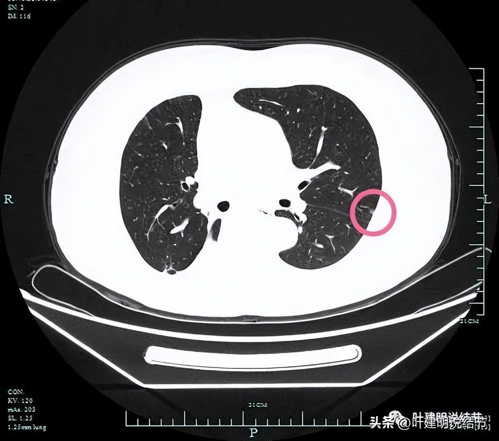 右下叶磨玻璃6mm结节基本上是癌,右下叶少许炎症上叶磨玻璃结节