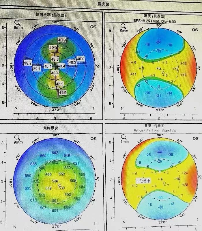 保定近视散光能做手术吗,南阳南石眼科医院近视价目表