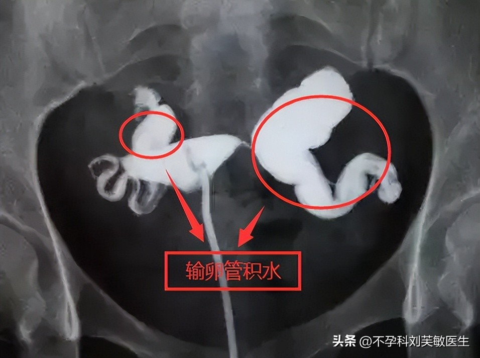 输卵管造影步骤图片解读,如何看懂输卵管造影片子